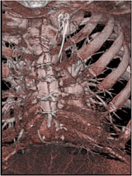 Planning of Redo Procedure - CTisus CT Scan