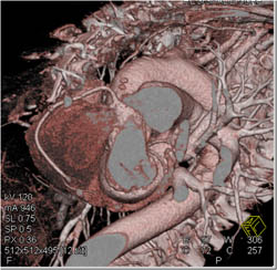 RCA and LAD Arise Off Right Cusp - CTisus CT Scan