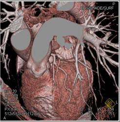 Pseudo-lesion in LAD- See Image Sequences - CTisus CT Scan