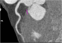 Myocardial Bridging - CTisus CT Scan