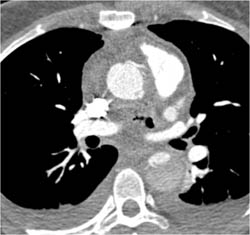 Aortic Dissection Where False Lumen Narrows the True Lumen - CTisus CT Scan