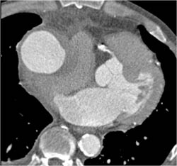 Pseudoaneurysm Near Site of Repair - CTisus CT Scan