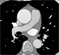 Dilated Aortic Root of Ascending Aorta - CTisus CT Scan