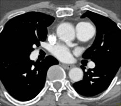 Reimplanted RCA and LAD Following Root Repair - CTisus CT Scan