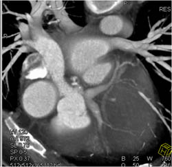 Dilated LAD and Circumflex - CTisus CT Scan