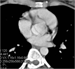 Bicuspid Valve - CTisus CT Scan