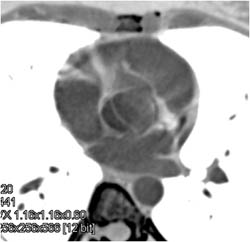 Bicuspid Valve - CTisus CT Scan