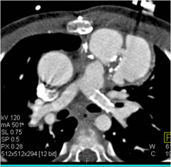 Stent in Left Pulmonary Artery and Pseudoaneurysm Off Rv - CTisus CT Scan