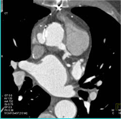 Dilated Left Main Coronary Artery After Reimplantation - CTisus CT Scan