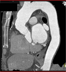 Dilated RCA Post Reimplantation After Root Repair - CTisus CT Scan