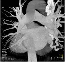 Stenosis Right Inferior Pulmonary Vein - CTisus CT Scan