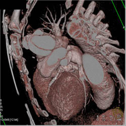 Stent in LAD - CTisus CT Scan