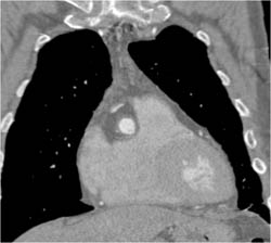 Dilated RCA at Reimplantation Site - CTisus CT Scan