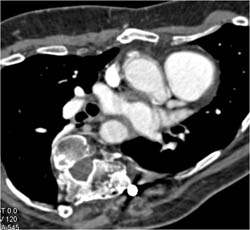 Aortic Root Repair - CTisus CT Scan