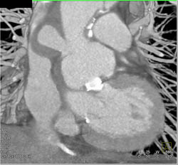 Pseudo-aneurysm Compresses the SVC - CTisus CT Scan