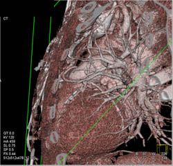 Patent Bypass Grafts - CTisus CT Scan