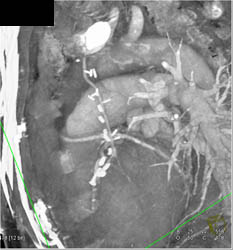 Patent Bypass Grafts - CTisus CT Scan