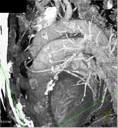 Patent Bypass Grafts - CTisus CT Scan