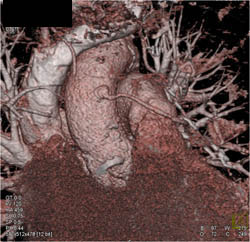 Patent Bypass Grafts - CTisus CT Scan