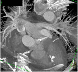 Severe Native Coronary Artery Disease- LAD and Circumflex Artery (CX) and RCA - CTisus CT Scan