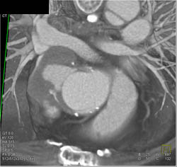 Type B Dissection With Prior Repair of Ascending Aorta- Also Note Pseudoaneurysm Off Ascending Aorta - CTisus CT Scan