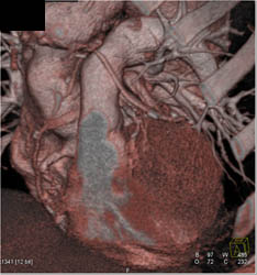 Dilated Reimplanted Origin of RCA - CTisus CT Scan