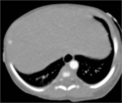 Double Arch With Ring Compresses Airway - CTisus CT Scan