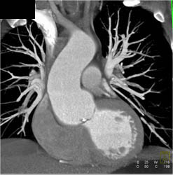 Dilated Aortic Root With Aortic Stenosis - CTisus CT Scan