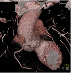 Stents in LAD - CTisus CT Scan