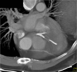 Bypass Grafts - CTisus CT Scan