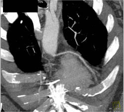 Bypass Grafts - CTisus CT Scan