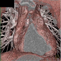 Dilated Ascending Aorta - CTisus CT Scan