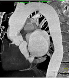 Repair of Septal Defect - CTisus CT Scan