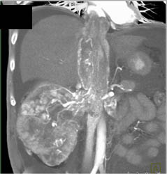 Renal Cell Carcinoma Extends Into Renal Vein, IVC, and Right Atrium - CTisus CT Scan