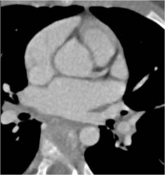 Coarctation of the Aorta - CTisus CT Scan