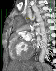 Coarctation of the Aorta - CTisus CT Scan