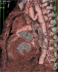 Coarctation of the Aorta - CTisus CT Scan