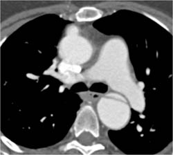 Dilated Origin of Venous Graft With Dissection of Descending Aorta - CTisus CT Scan