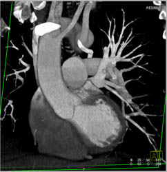 Incomplete Double Aortic Arch With Mirror Branching - CTisus CT Scan