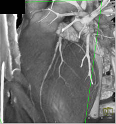 Minimal LAD Disease - CTisus CT Scan