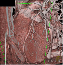 Minimal LAD Disease - CTisus CT Scan