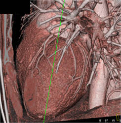 Minimal LAD Disease - CTisus CT Scan