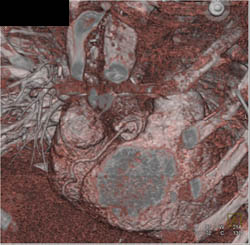 Implanted RCA - CTisus CT Scan