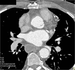 Bypass Grafts- Coronary Artery Bypass Graft (CABG) - CTisus CT Scan