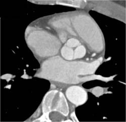 Repair of Coarctation of the Aorta (COA) With Stent - CTisus CT Scan