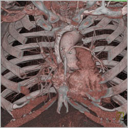 Bypass Grafts With 3D Planning for Re-do Procedure - CTisus CT Scan