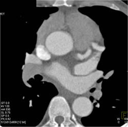 Dilated LAD - CTisus CT Scan