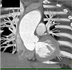 Dilated Ascending Aorta With Bicuspid Valve - CTisus CT Scan