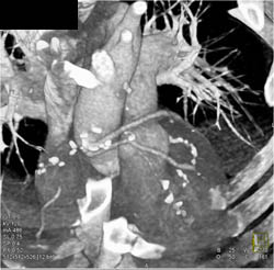 Bypass Grafts - CTisus CT Scan