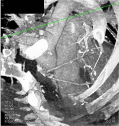 Bypass Grafts - CTisus CT Scan